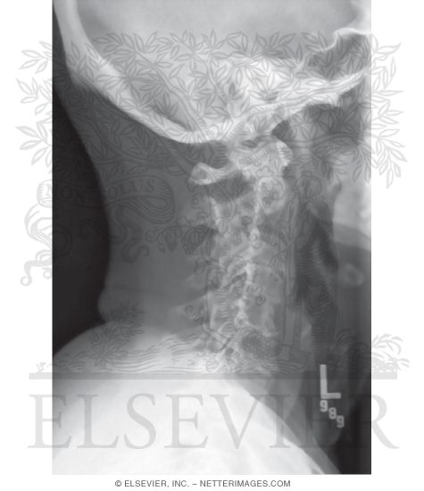 Watermarked preview of unlabeled image: Lateral X-Ray of Cervical Vertebrae (Spine)