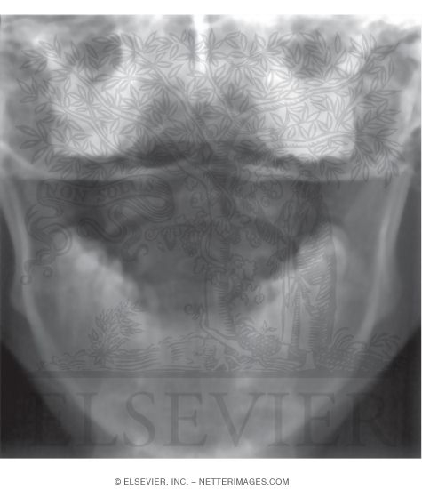Traditional X-Ray of Atlantoaxial Joint (Open Mouth Odontoid View)