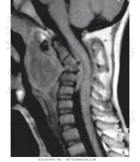Watermarked preview of unlabeled image: Sagittal T1 MRI Without Contrast