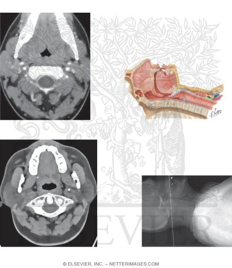 Axial CT at C2 and C1