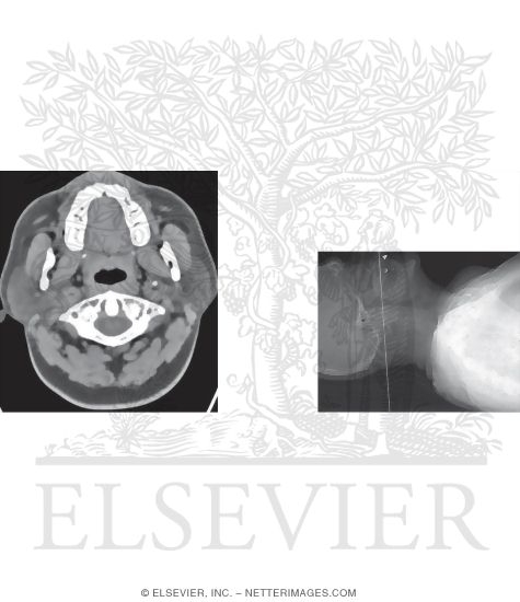 Watermarked preview of unlabeled image: Axial CT Through C1 and the Maxilla
