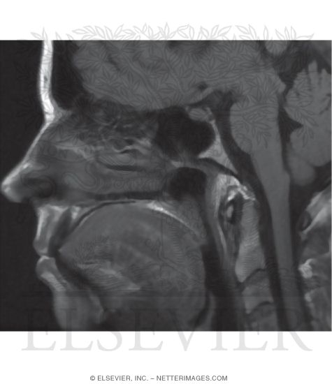 Watermarked preview of unlabeled image: Sagittal T1 MRI Through the Lateral Nasal Wall and Nasoparynx