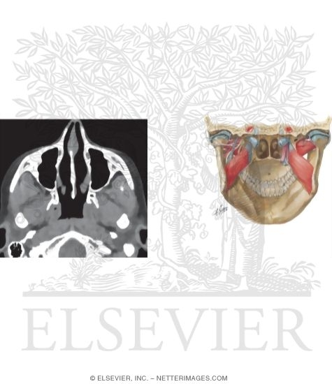 Axial CT With a Soft Tissue Window Through the Nasal Cavity, Maxillary Sinuses, and Nasopharynx