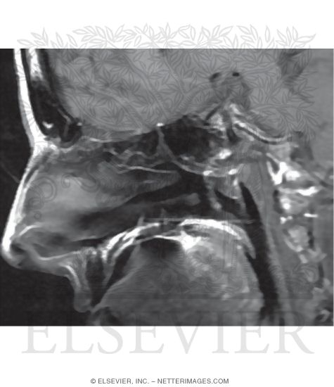 Midsagittal T1 MRI Through the Frontal, Ethmoid, and Sphenoid Sinuses