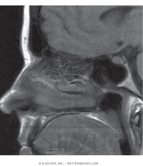 Watermarked preview of unlabeled image: Midsagittal T1 MRI Through the Upper Bony Nasal Septum
