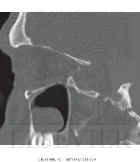 Sagittal CT Reconstruction With a Bone Window Through the Orbit and a Retention Cyst In the Maxillary Sinus