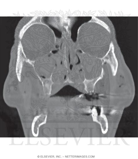Coronal CT Reconstruction of the Sinus and Orbit