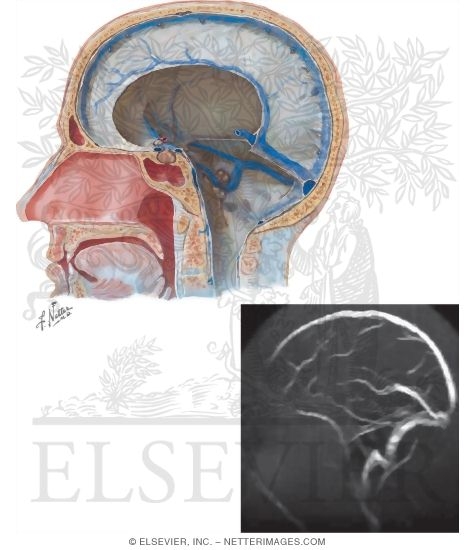 Dural Venous Sinuses