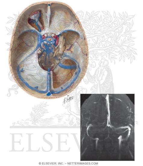 Watermarked preview of unlabeled image: Dural Venous Sinuses