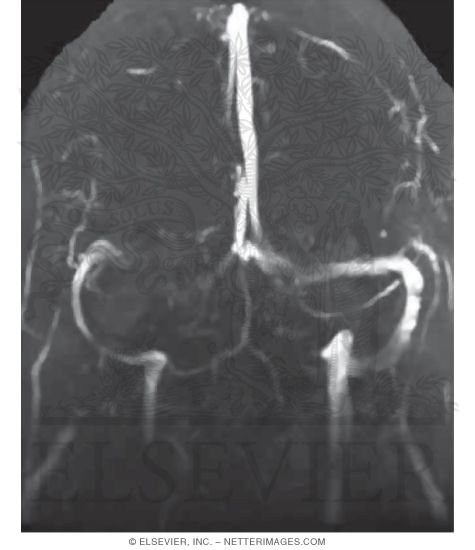 Coronal View MR Venogram of Dural Sinus Circulation