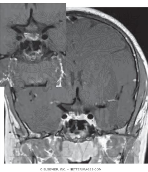 T1 Coronal MRI With Contrast Highlighting the Cavernous Sinus