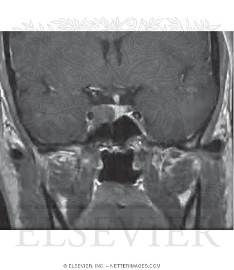 Coronal MRI Showing a Small Tumor (Microadenoma) In the Right Half of