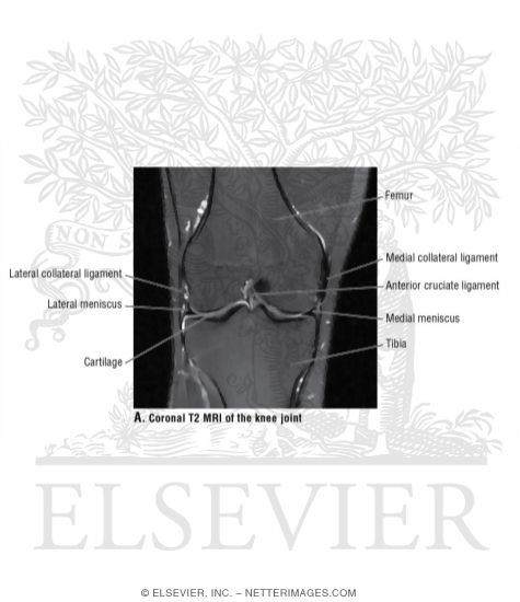 Coronal T2 MRI of the Knee Joint
