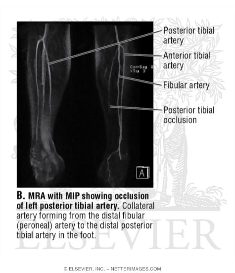 MRA With MIP Showing Occlusion of Left Posterior Tibial Artery