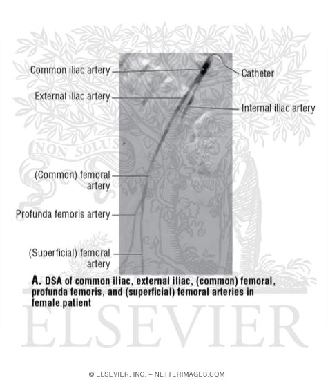 DSA of Common Iliac, External Iliac, (Common) Femoral, Profunda Femoris, and (Superficial) Femoral Arteries In Female Patient