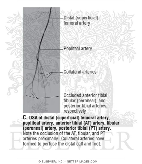 DSA of Distal (Superficial) Femoral Artery, Popliteal Artery, Anterior Tibial (AT) Artery, Fibular (peroneal) Artery, Posterior Tibial (PT) Artery