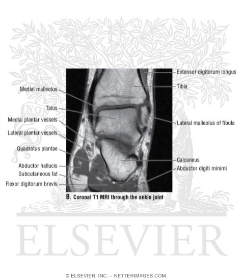 Watermarked preview of unlabeled image: Coronal T1 MRI Through the Ankle Joint