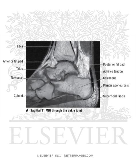 Sagittal T1 MRI Through the Ankle Joint