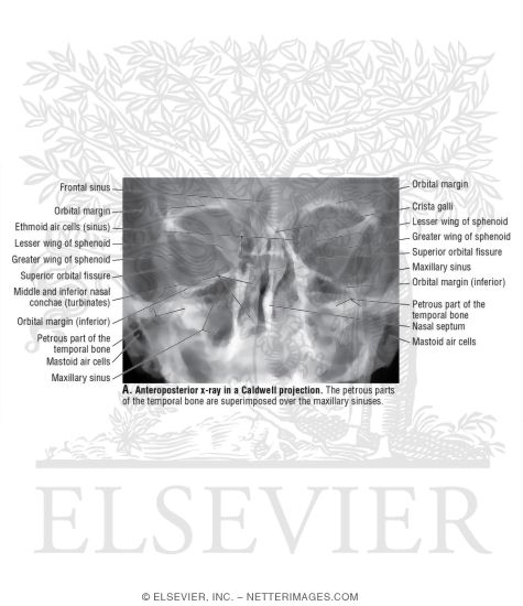 Anteroposterior X-Ray In a Caldwell Projection