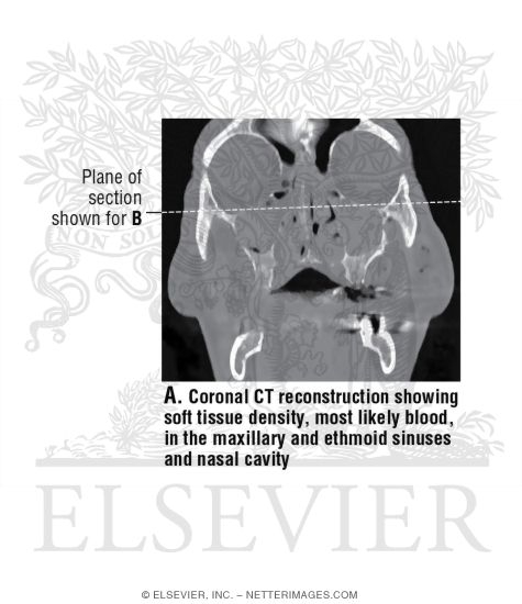 Watermarked preview of unlabeled image: Coronal CT Reconstruction of the Sinus and Orbit