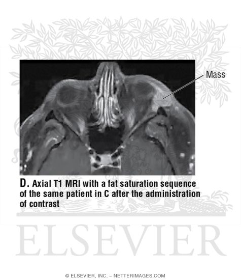 Watermarked preview of unlabeled image: Axial T1 MRI of the Sinus and Orbit
