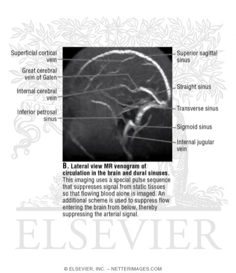 Lateral View MR Venogram Of Circulation In The Brain And Dural Sinuses lateral-view-mr-venogram-of-circulation-in-the-brain-and-dural-sinuses