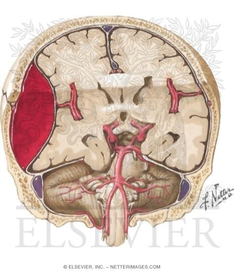 Coronal Section Showing an Epidural Hematoma
