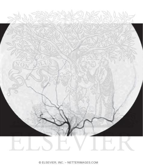 Watermarked preview of unlabeled image: Digital Catheter Angiogram of the Left External Carotid Artery