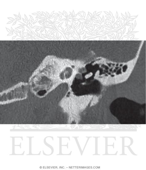 CT Reconstruction of the Left Temporal Bone