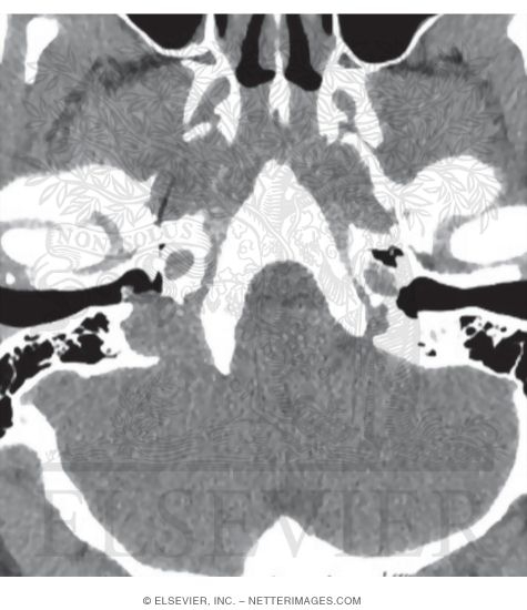 Axial CT Showing the Jugular Bulb Extending Into the Middle Ear Cavity