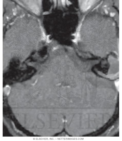 Watermarked preview of unlabeled image: MRI Showing a Mass (Cholesteatoma) In the Epitympanic Recess and Mastoid Antrum