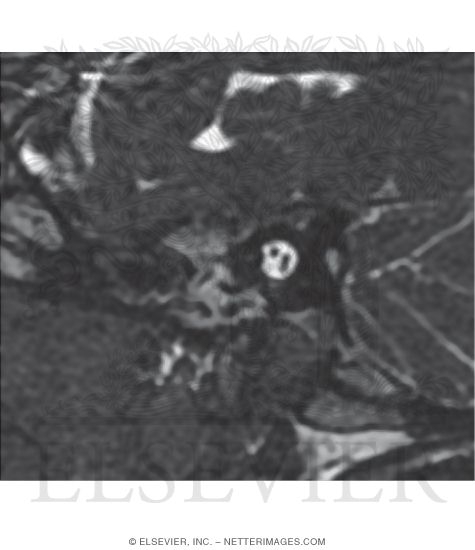 T2 MRI In a Sagittal Plane Through the Internal Acoustic Meatus of a Deaf Patient With Congenital Absence of the Cochlear Nerve