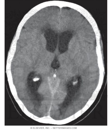 Watermarked preview of unlabeled image: Axial CT of a Patient With Obstructive Hydrocephalus