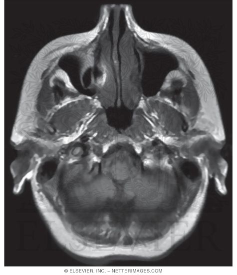 foramen magnum mri