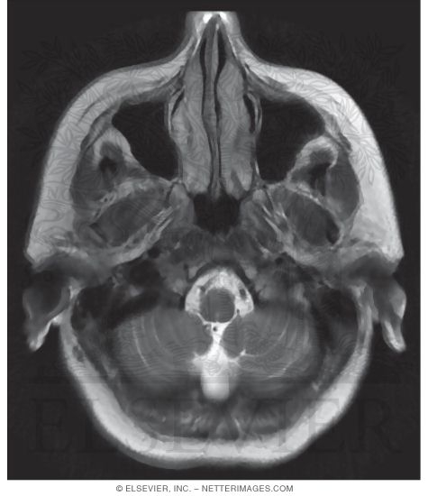 T2 Axial MRI Just Above the Foramen Magnum