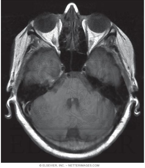 Watermarked preview of unlabeled image: T1 Axial MRI Through the Cerebellum, Temporal Lobes, and Eye
