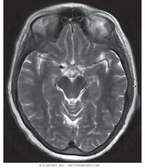 Watermarked preview of unlabeled image: T2 Axial MRI Though the Optic Chiasm