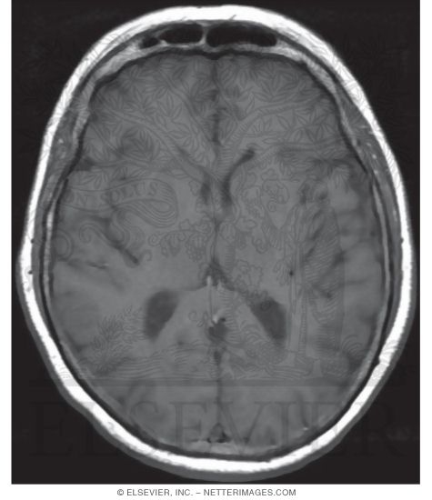 Watermarked preview of unlabeled image: T1 Axial MRI Through the Thalamus and Lateral Ventricles