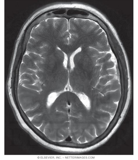 T2 Axial MRI Through the Thalamus and Lateral Ventricles