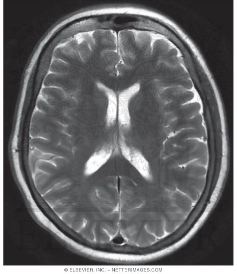 Watermarked preview of unlabeled image: T2 Axial MRI Through the Lateral Ventricles