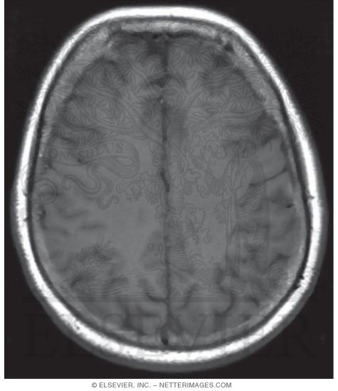 Watermarked preview of unlabeled image: T1 Axial MRI Through the Middle of the Cerebral Hemispheres