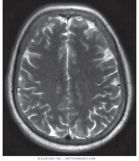 Watermarked preview of unlabeled image: T1 Axial MRI Through the Middle of the Cerebral Hemispheres