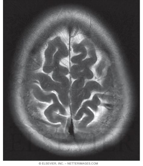 Watermarked preview of unlabeled image: T2 Axial MRI Through the Thalamus and Lateral Ventricles
