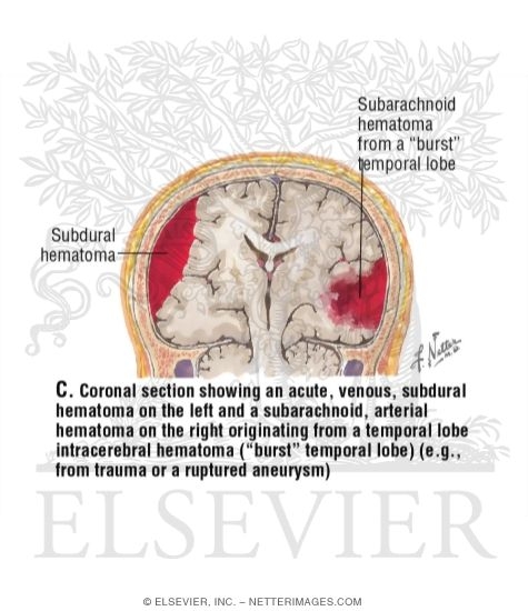 Subdural Hematomas
