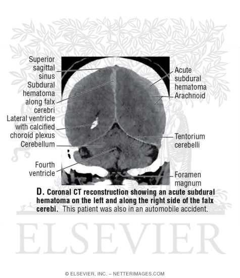 Watermarked preview of unlabeled image: Coronal CT Reconstruction Showing an Acute Subdural Hematoma