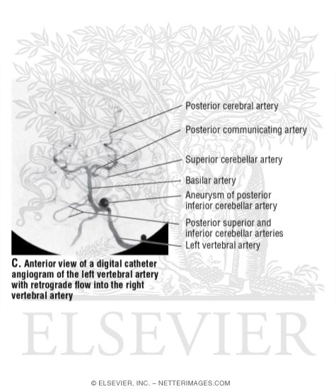 Anterior View of a Digital Catheter Angiogram of the Left Vertebral Artery