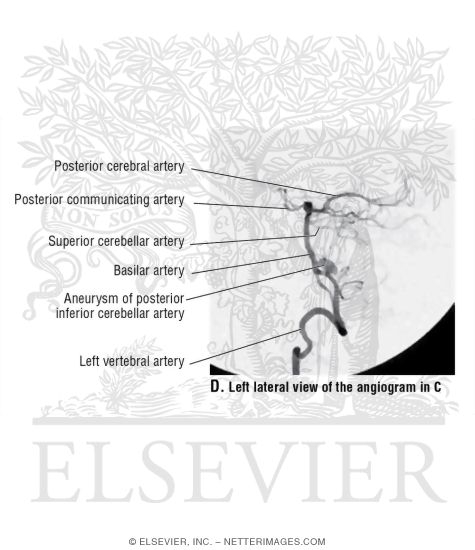 Left Lateral View of a Digital Catheter Angiogram of the Left Vertebral Artery
