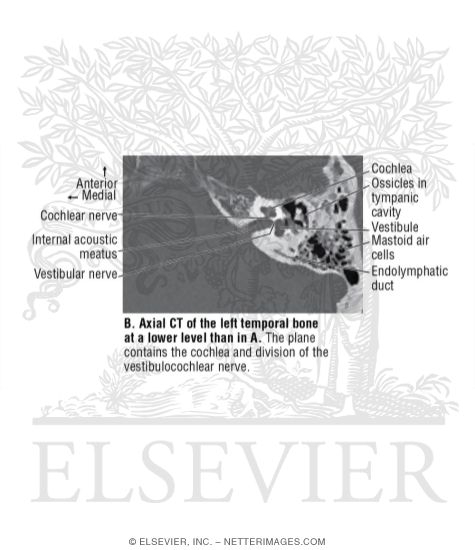 Watermarked preview of unlabeled image: Axial CT of the Left Temporal Bone