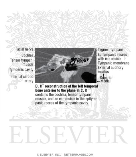 Watermarked preview of unlabeled image: CT Reconstruction of the Left Temporal Bone