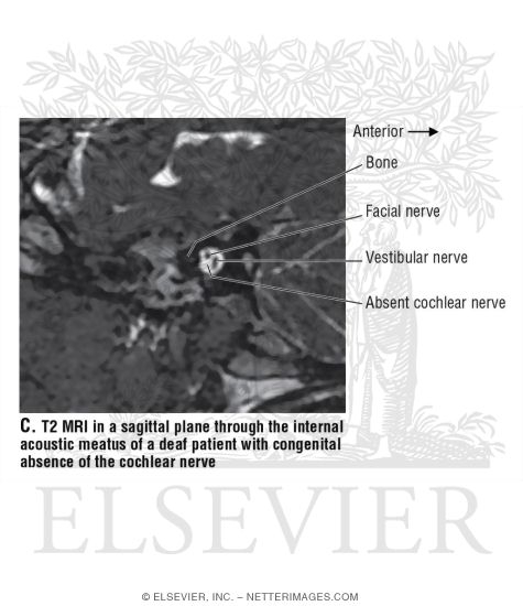 T2 MRI In a Sagittal Plane Through the Internal Acoustic Meatus of a Deaf Patient With Congenital Absence of the Cochlear Nerve